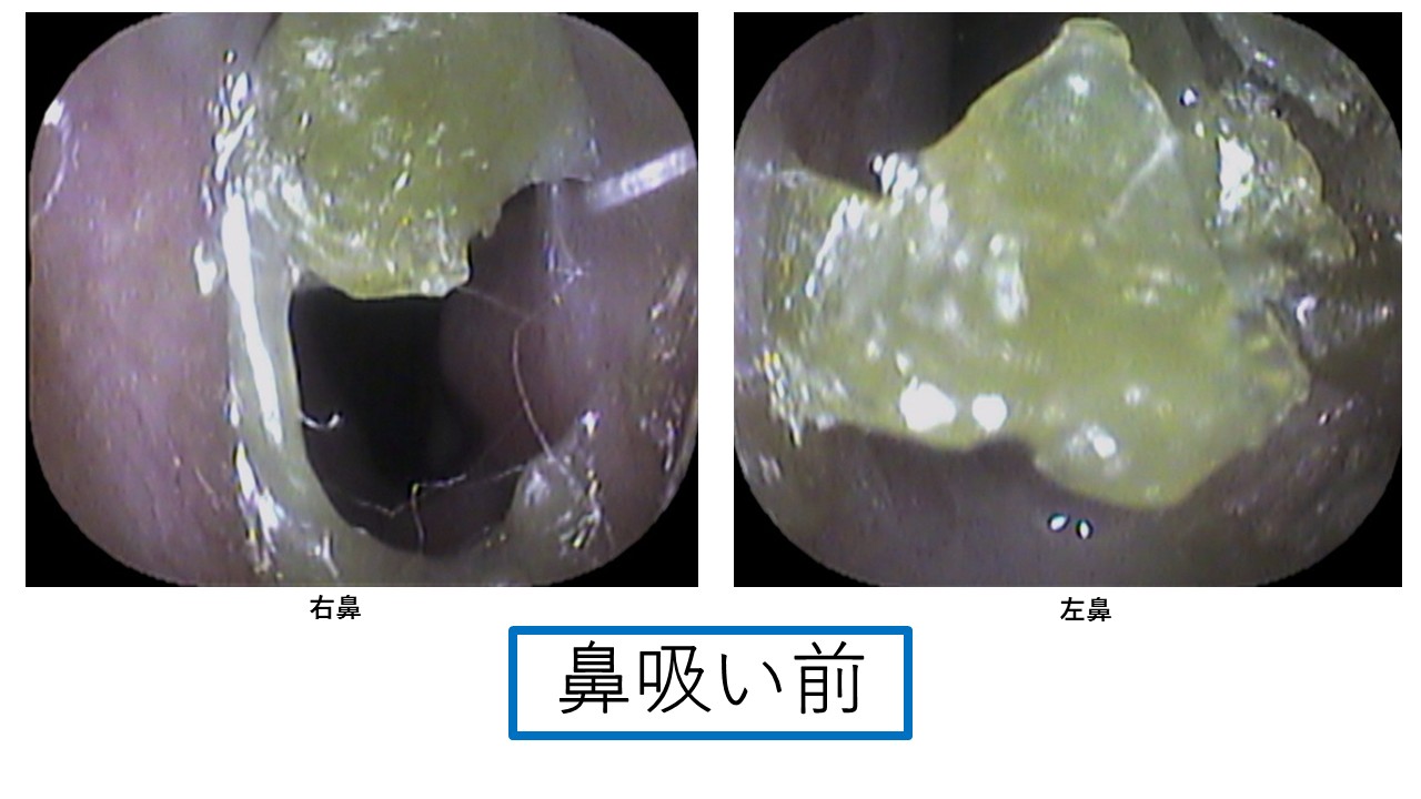 鼻吸い後　